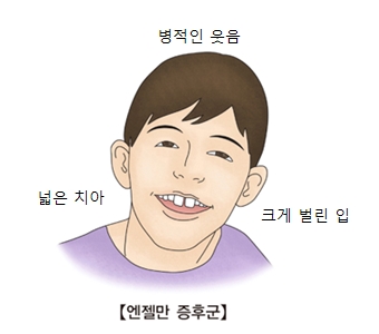 엔젤만 증후군