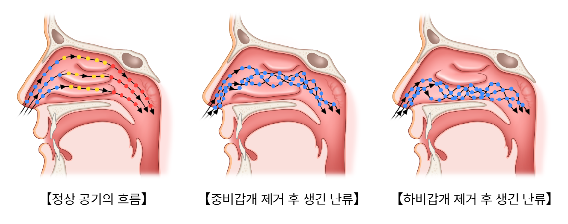 빈코증후군 이미지