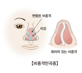 비중격만곡증